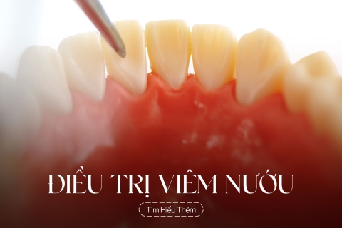 Điều trị viêm nướu